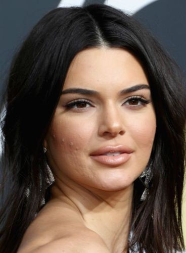 Kendal_Jenner_Model_Acne